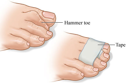 hammertoe treatments