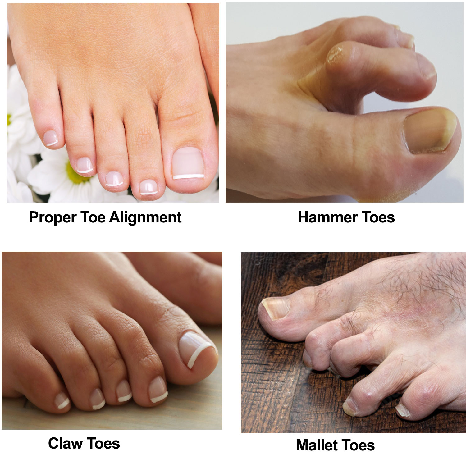 toe comparisons - hammertoes, claw toes, mallet toes